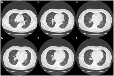 Potential co-infection of influenza A, influenza B, respiratory syncytial virus, and Chlamydia pneumoniae: a case report with literature review